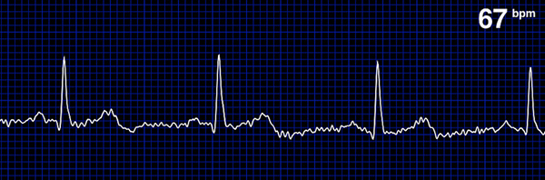 echocardiogram