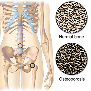 Osteoporosis_Locations